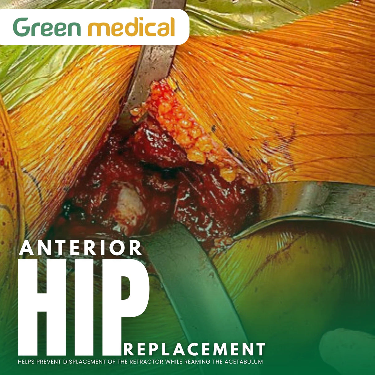 Chandran Anterior Hip Retractor–Total Hip Replacement (THR) Surgical Instrument