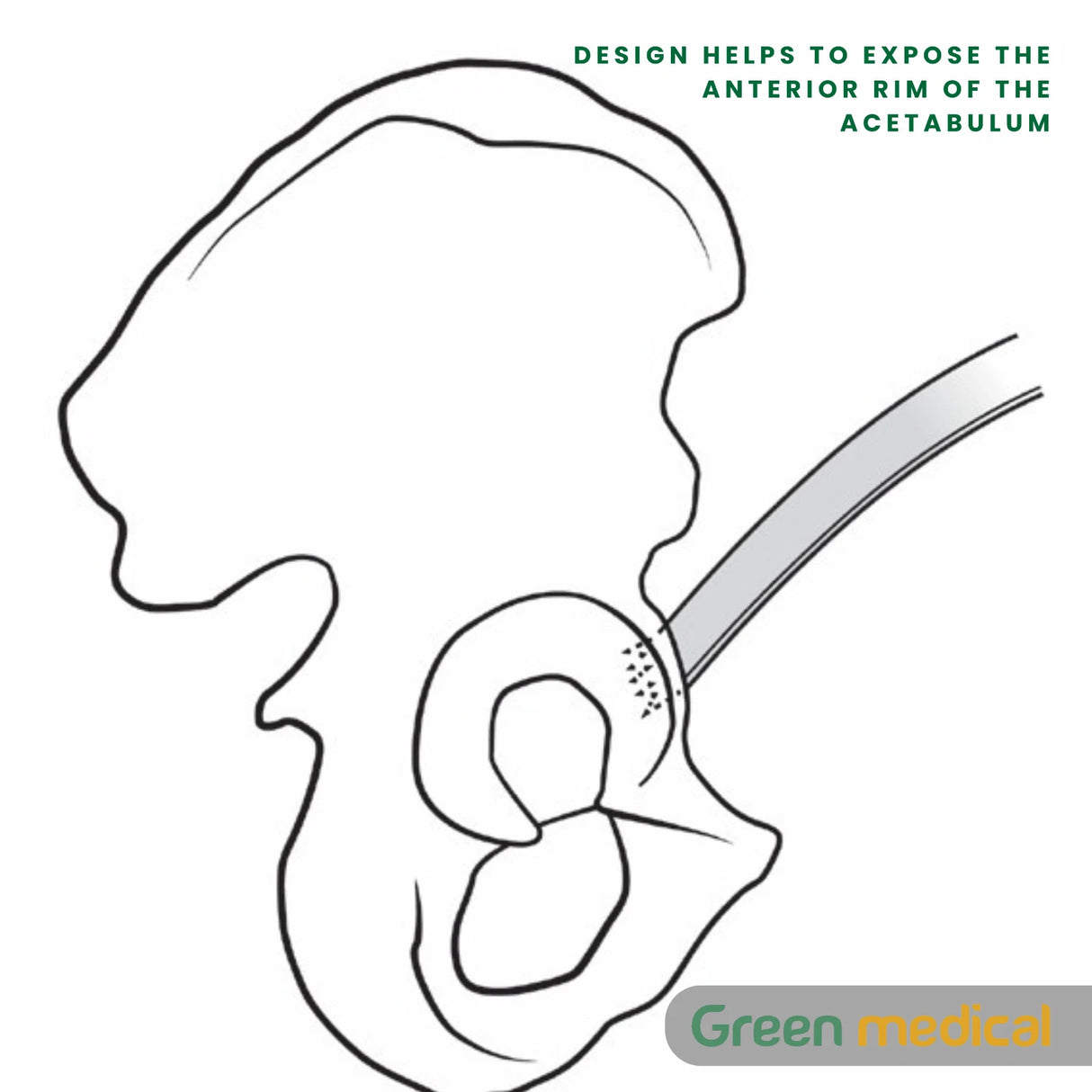 Chandran Anterior Hip Retractor–Total Hip Replacement (THR) Surgical Instrument