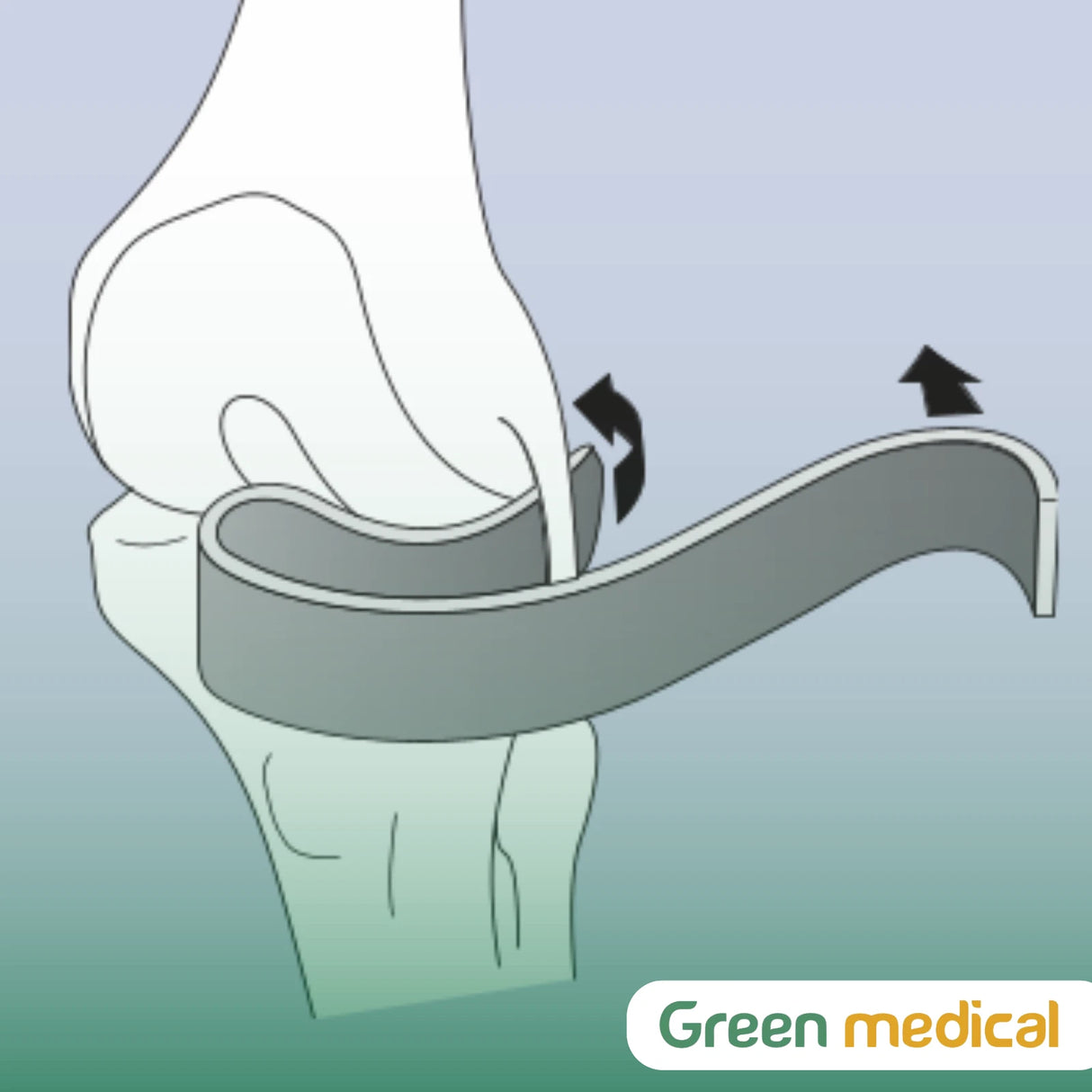 S-Shaped Total Knee Retractors – Orthopedic TKA Surgical Instrument